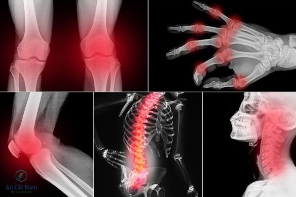 Một số nguyên nhân không do bệnh lý dẫn đến tình trạng đau nhức xương khớp