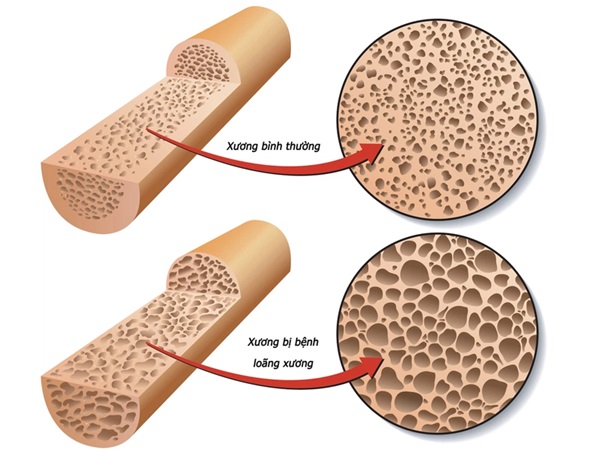 Tác hại của bệnh loãng xương do đâu?