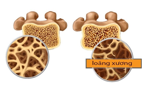 Loãng xương là tình trạng xương bị giòn xốp và có bắt đầu mỏng dần