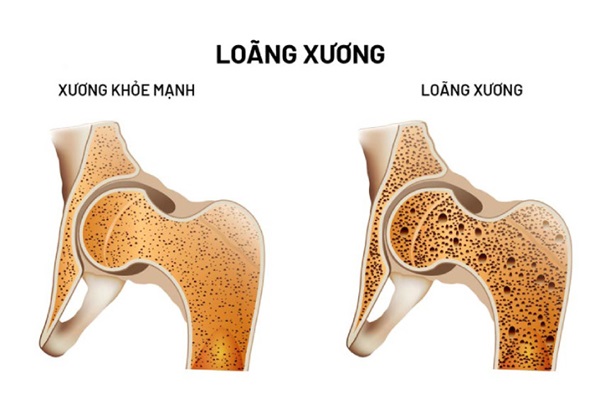 Sự khác nhau giữa xương khỏe mạnh và loãng xương