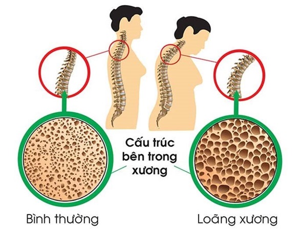 Cấu trúc bên trong xương của người bình thường và người loãng xương